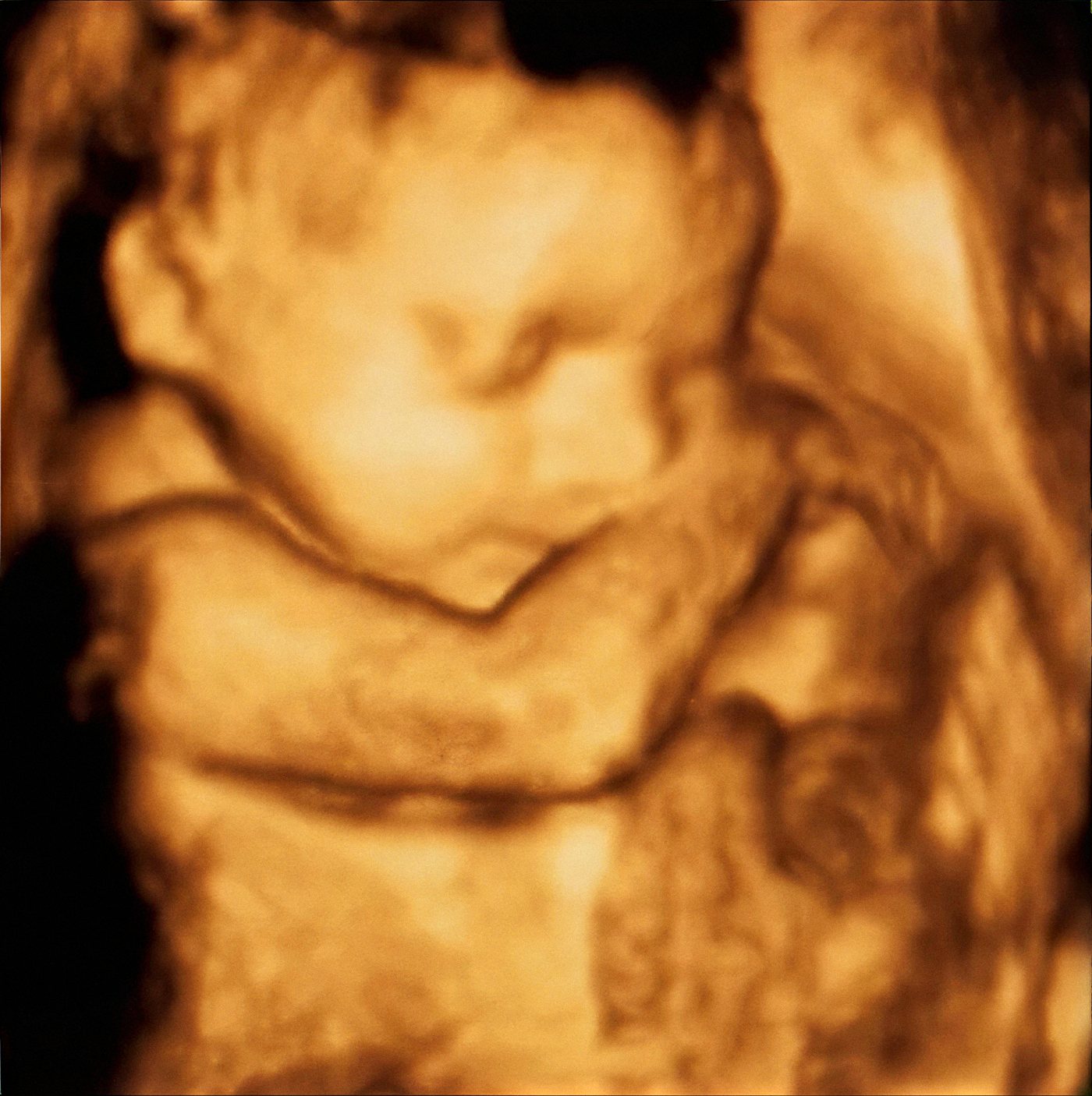 Exemplo de ultrassom 3D de bebê
